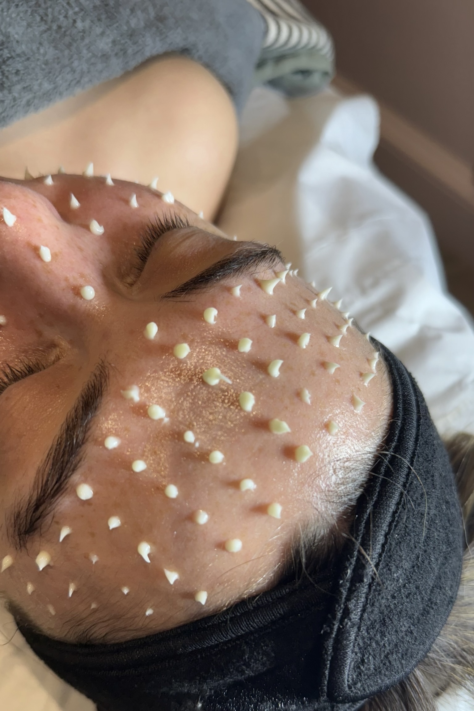 microneedling-edinburgh